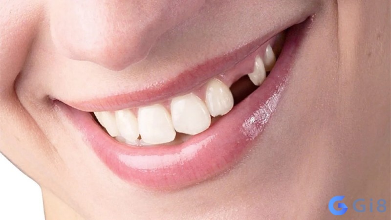 Mơ thấy rụng răng khiến nhiều người cảm thấy hoảng sợ Mơ thấy rụng răng khiến nhiều người cảm thấy hoảng sợ