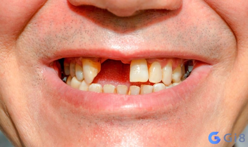 Mộng thấy gãy răng cửa cảnh báo tai họa sắp đến Mộng thấy gãy răng cửa cảnh báo tai họa sắp đến