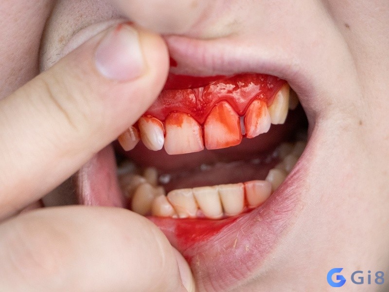 Mơ gãy răng chảy máu không hẳn là điềm xấu Mơ gãy răng chảy máu không hẳn là điềm xấu