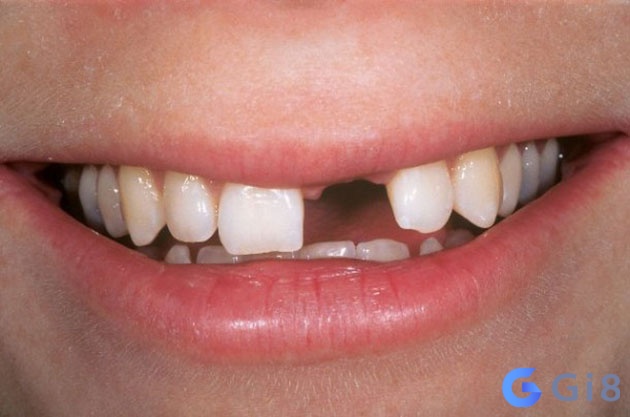 Mơ bị gãy răng đánh con gì rất được anh em đề thủ quan tâm Mơ bị gãy răng đánh con gì rất được anh em đề thủ quan tâm