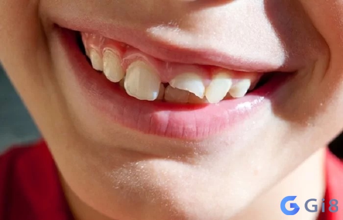 Mơ thấy răng bị gãy hãy quan tâm đến sức khỏe nhiều hơn Mơ thấy răng bị gãy hãy quan tâm đến sức khỏe nhiều hơn