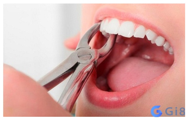 Ngủ mơ thấy đi nhổ răng không phải là điềm tích cực Ngủ mơ thấy đi nhổ răng không phải là điềm tích cực