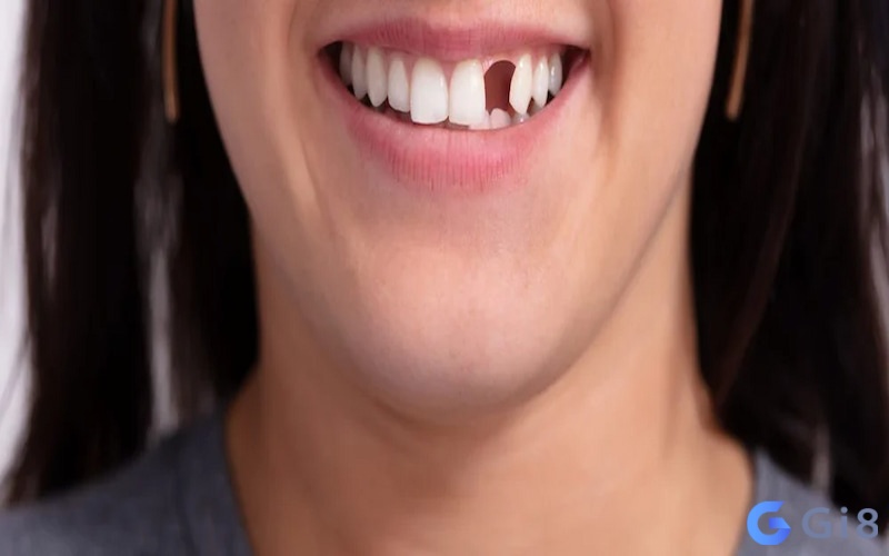 Mơ thấy gãy răng cũng có thể là biểu hiện chứng trầm cảm Mơ thấy gãy răng cũng có thể là biểu hiện chứng trầm cảm, nếu mơ thấy gãy răng đánh con gì mới dễ ăn?