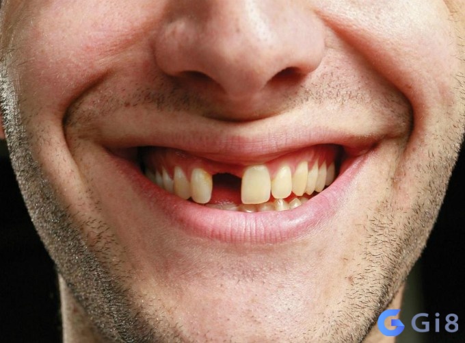 Phân tích gãy răng đánh con gì để hút tài lộc chiều nay? Phân tích gãy răng đánh con gì để hút tài lộc chiều nay?